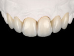 Final porcelain restorations after finishing and final polishing. Digital photography was used to evaluate the soft-tissue levels and symmetry as well as to help with the planning of corrections and improvements.