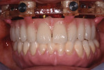 Retracted photograph of chairside converted PMMA transitional hybrid prosthesis.