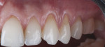 Fig 6. A combination NCCL affecting both the crown and root portion of teeth Nos. 9 through 13.