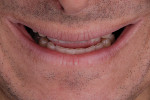 Fig 1. Preoperative smile of case example.