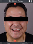Fig 9. Digital smile design full-face photograph, which was a still shot of a video slider, allowed the clinician to share “before” and “after” images with the patient.
