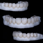 Fig 6. Final restorations on models in three different views.