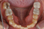 Fig 6. Preoperative mandibular arch showing anterior crowding and wear.