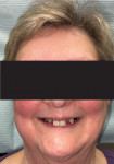 A smile in which the upper central incisors and cuspids lay on the lower lip is indicative of a collapsed VDO.