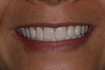 Fig 7. Prior to sending the temporary prototypes for final restoration fabrication, the smile design and occlusal scheme were refined to meet the patient’s esthetic demands and occlusal comfort.