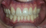 Fig 3. Anterior retracted view before treatment, demonstrating 3.5 mm midline shift to the patient’s right side. Occlusal disease with general abfractions was evident in the premolar and canine regions in all four quadrants. Axial inclination of the maxillary anterior teeth and premolars converged toward the patient’s chin.