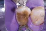 The preparation and immediate dentin sealing were completed under rubber dam isolation, allowing time for optimal maturation of the dentin bond (CLEARFIL™ SE Protect, Kuraray Noritake).
