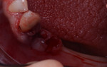 Extraction site of a non-restorable mandibular premolar following placement of a platelet-rich fibrin plug in the socket.