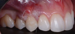 Postoperative view of a treatment involving a tunnel preparation to allow repositioning of the soft tissue to cover isolated gingival recession on a canine. After a connective tissue graft was harvested from the palate and placed into the tunnel, the tissue was secured with sutures.