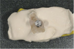 The gap between the implant analog and the cast was sealed with orthodontic wax before a second pour of dental stone was added to imbed the implant analog in the cast.