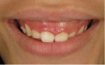 Pretreatment smile photograph showing excessive gingival display resulting from altered passive eruption and vertical maxillary excess.