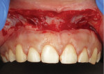 Removal of a strip of mucosa apical to the mucogingival junction from tooth No. 4 to tooth No. 13.