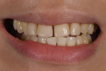 Pretreatment smile photograph of a patient who had previously undergone treatment to close her large maxillary midline diastema but was very unhappy with the appearance of her smile. Note how guarded the smile is, which is often the case with patients who are self-conscious about the appearance of their teeth.