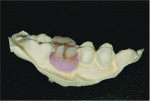 Fig 8. View of the cast with the reassembled tooth and gingival material.