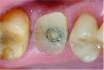 Fig 20. View of the custom healing abutment after a 5-month healing period.